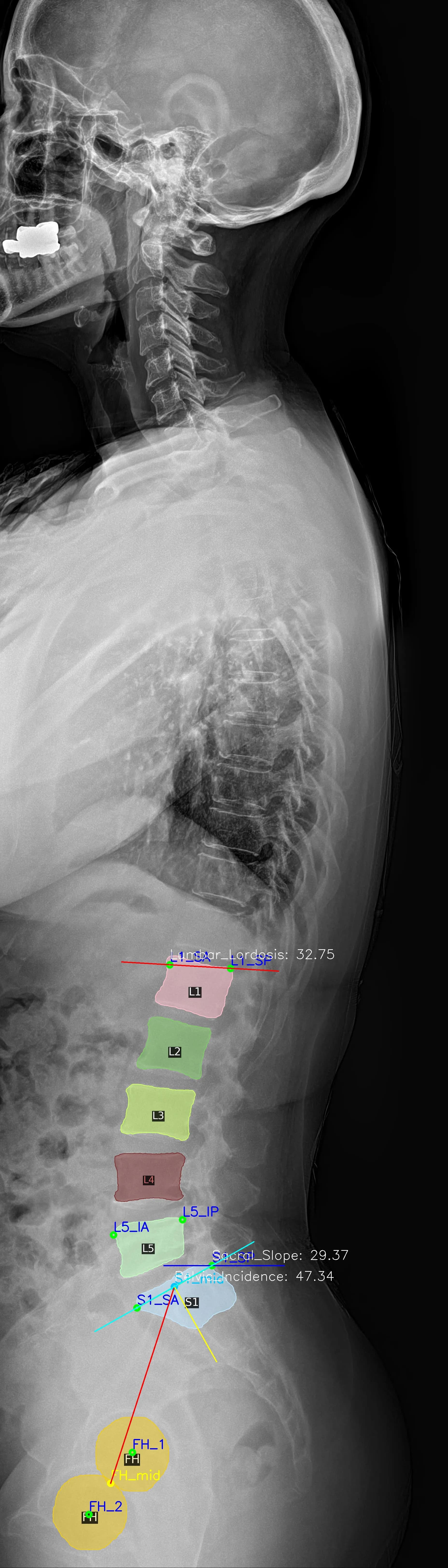 Whole Spine LAT result