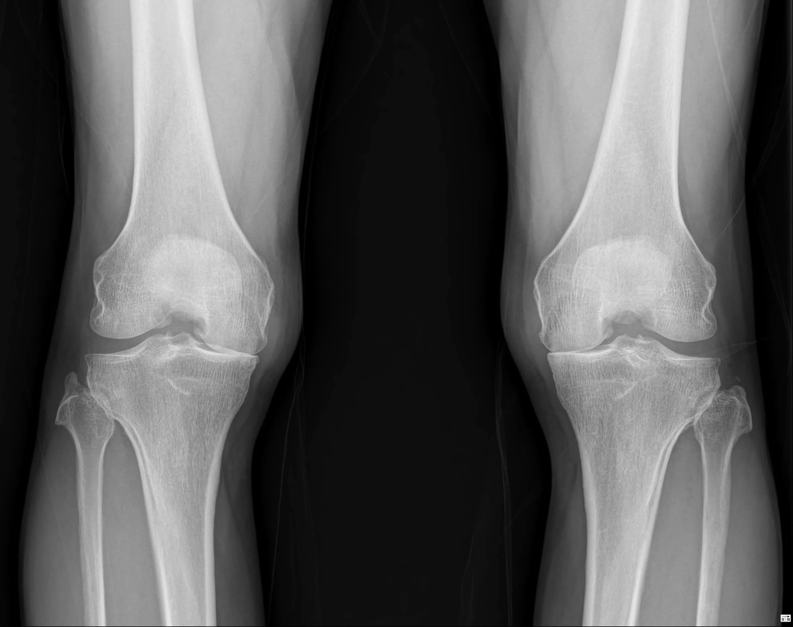 Knee KL original