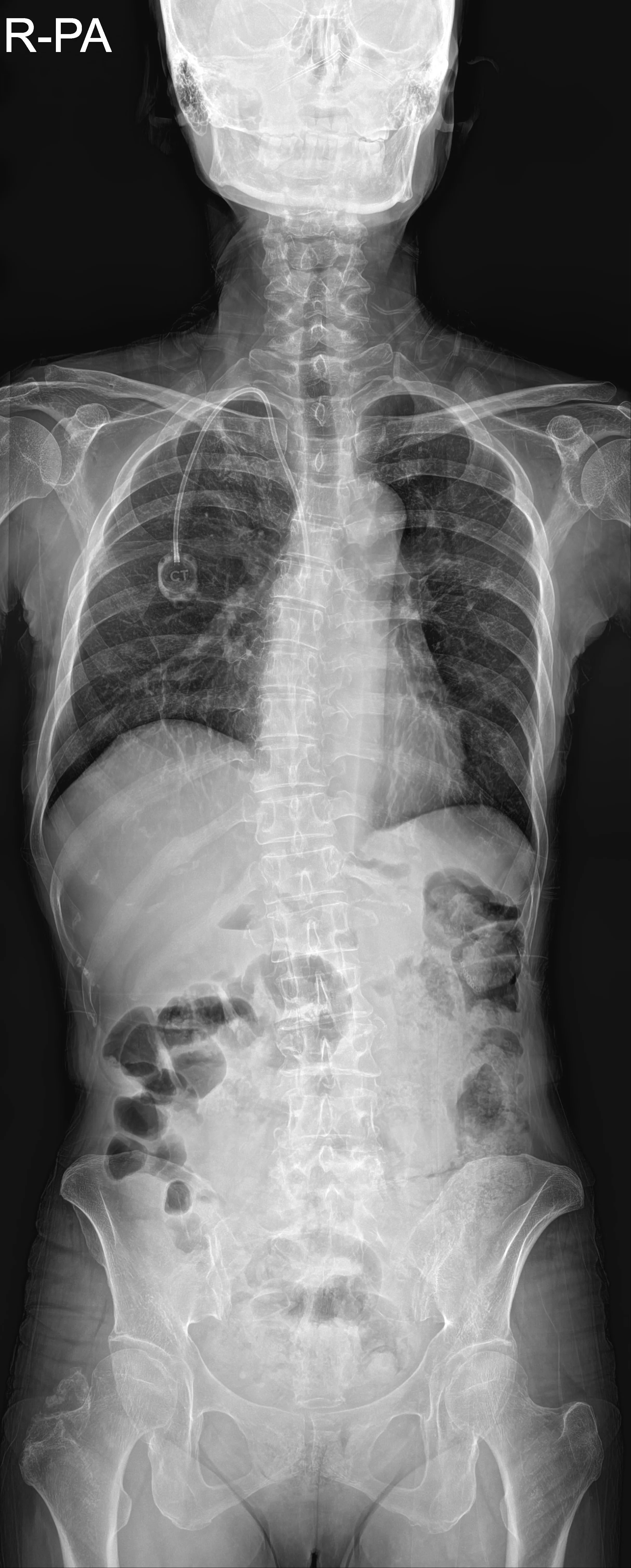 Whole Spine AP original