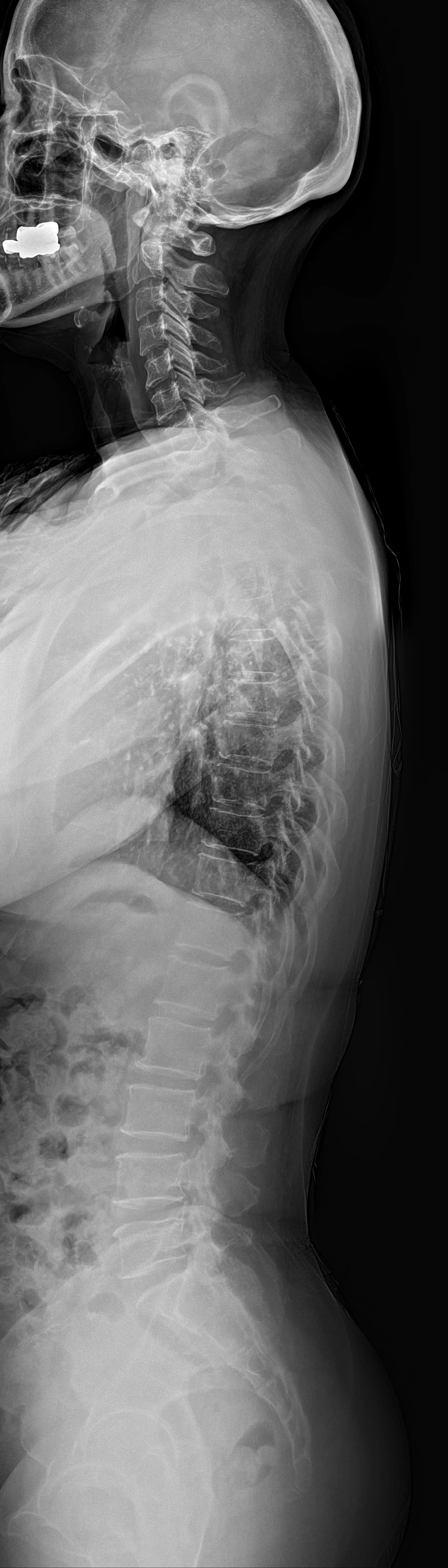 Whole Spine LAT original