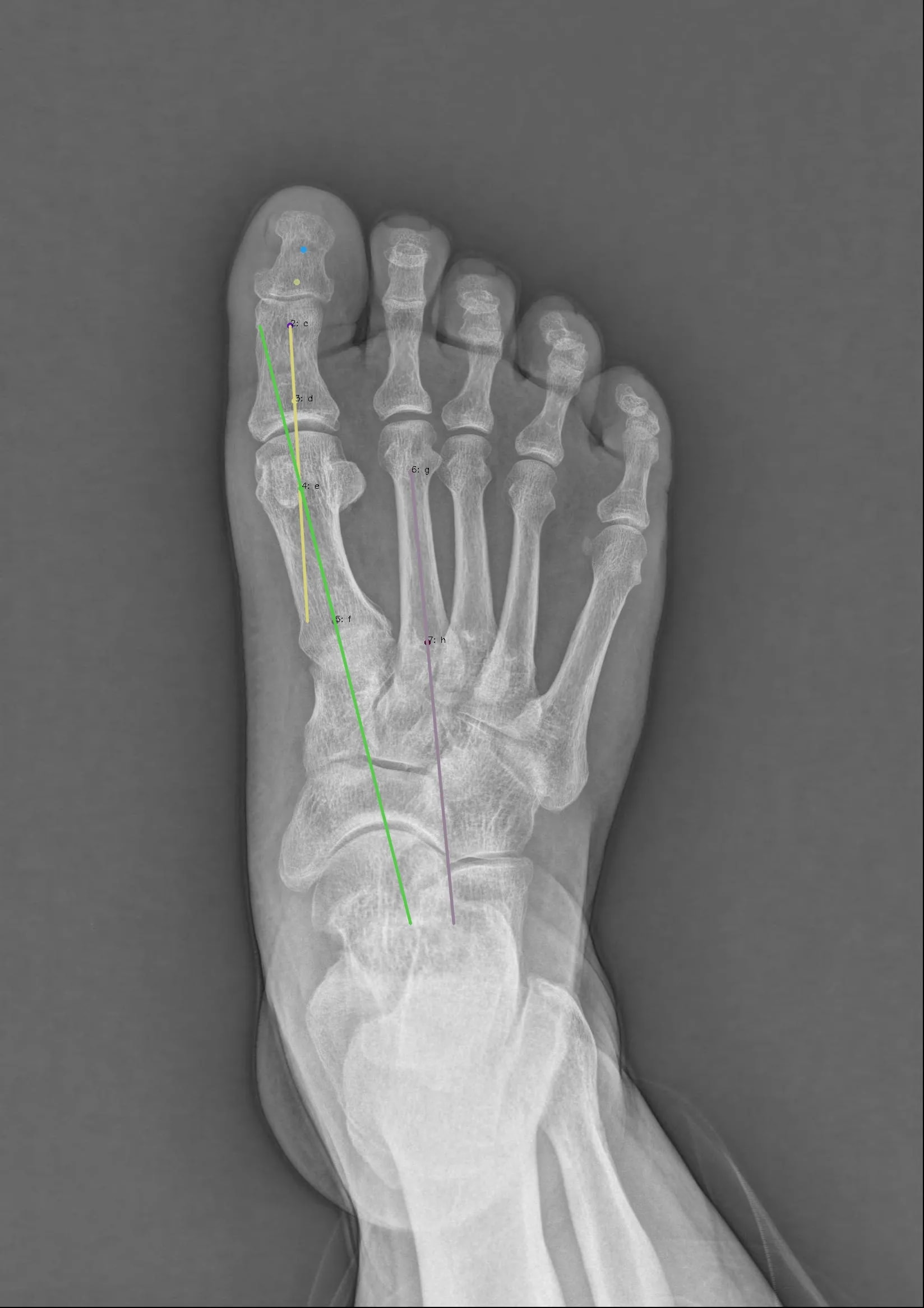Foot AP result