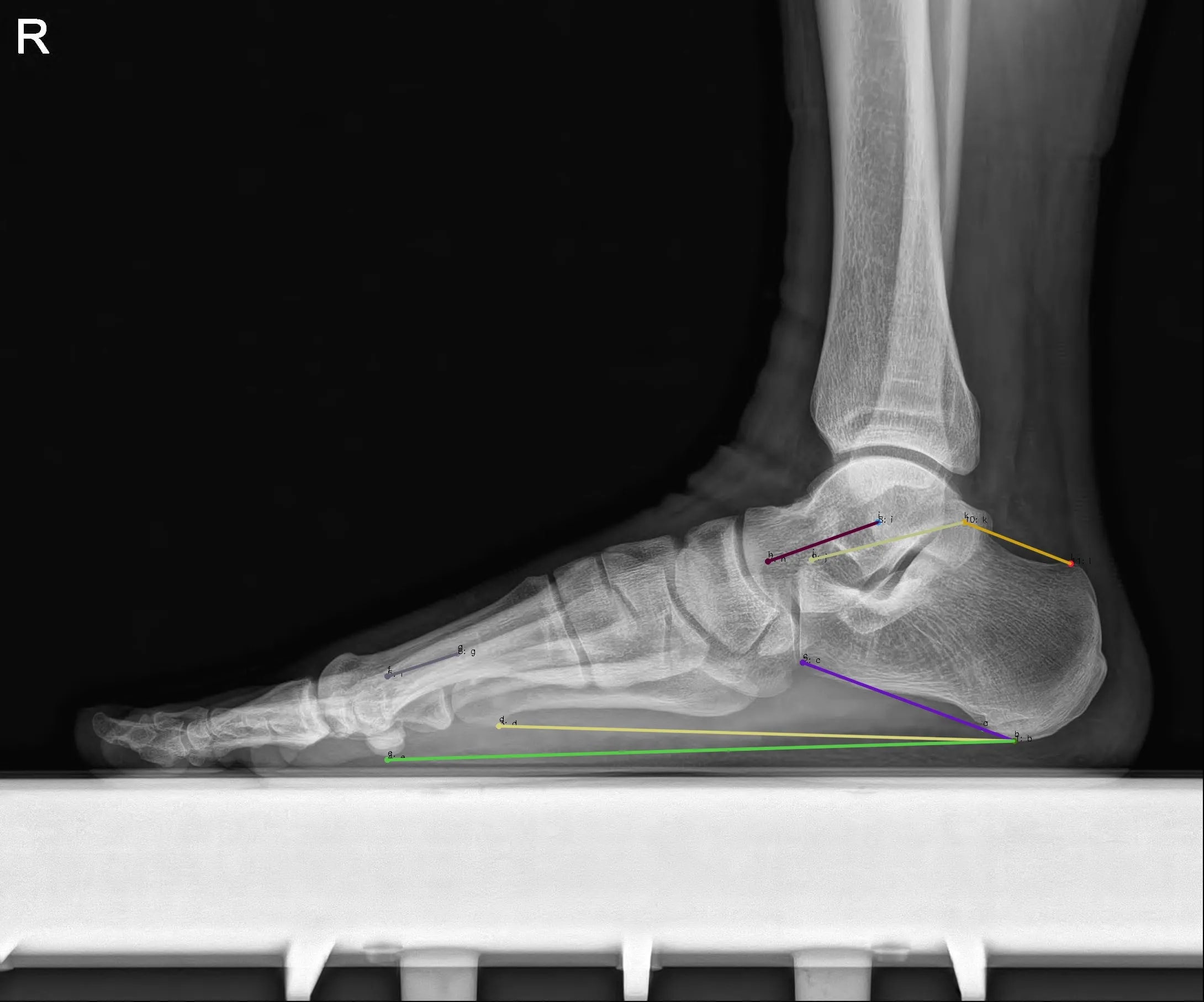 Foot LAT result