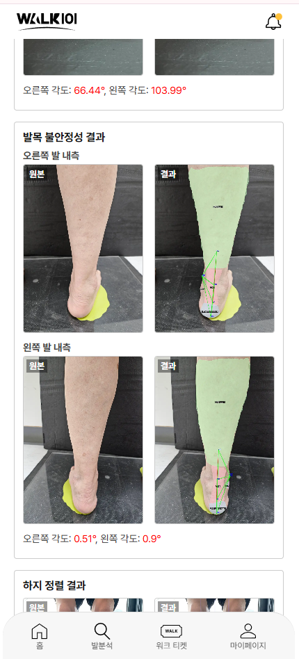 발목 불안정성